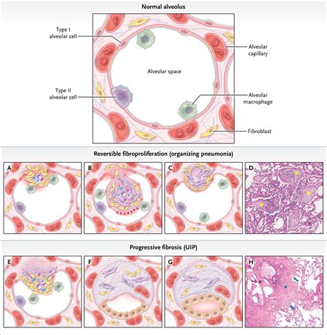 cryptogeen|Cryptogenic organising pneumonia: current understanding of an。